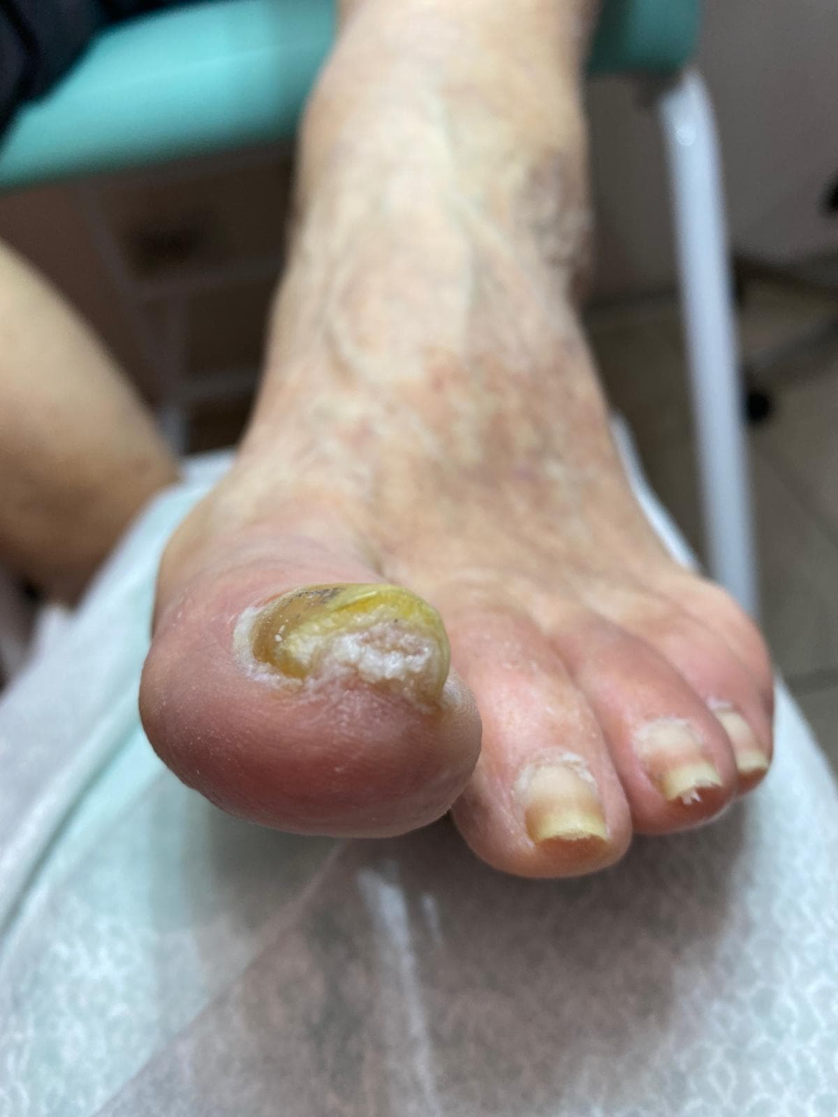 Pedicure Curativo Immagine esempio di unghia ipertrofica